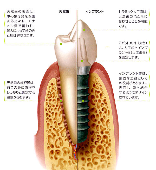 インプラント治療とは